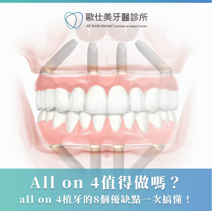 All on 4值得做嗎？all on 4植牙的8個優缺點一次搞懂！