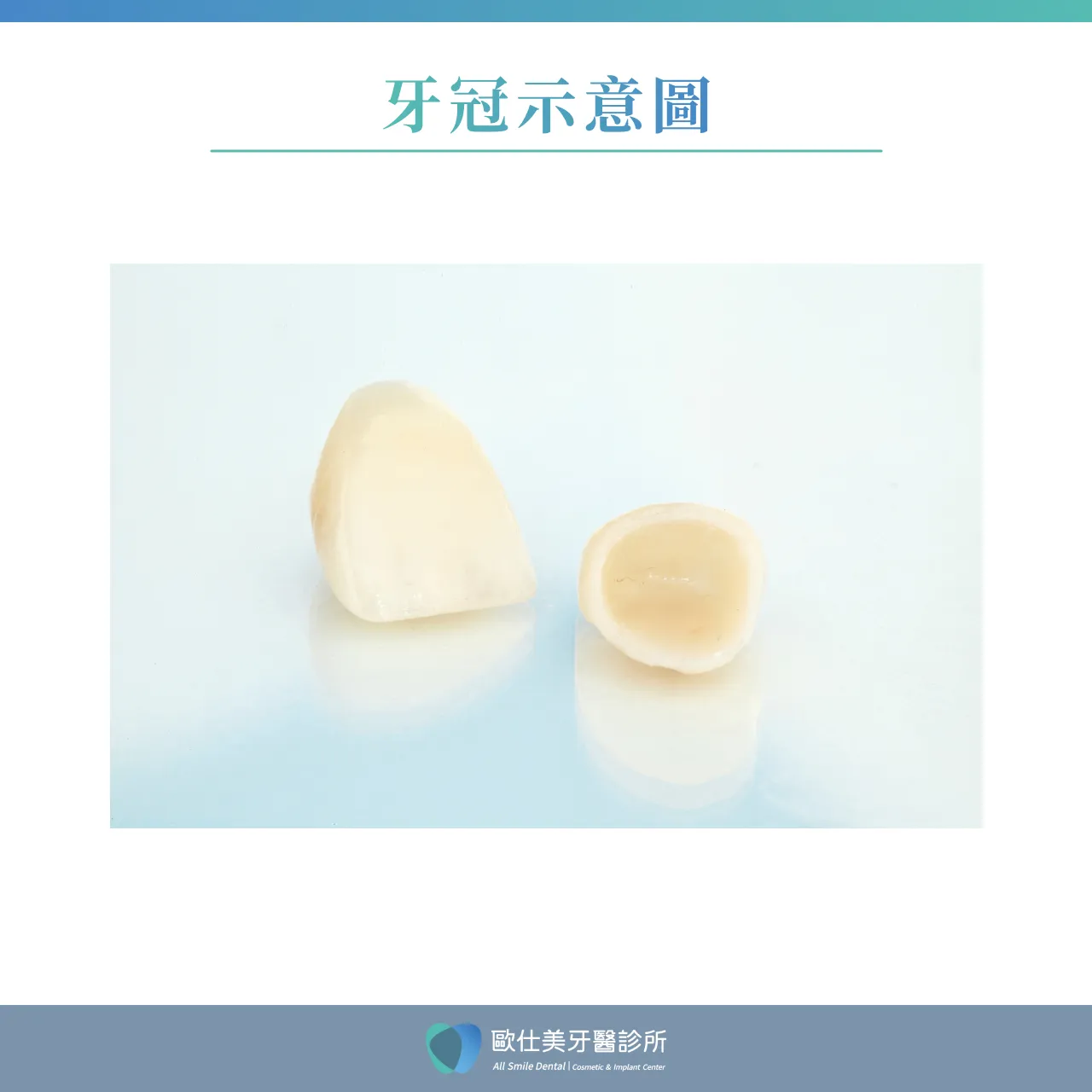 牙冠／牙套