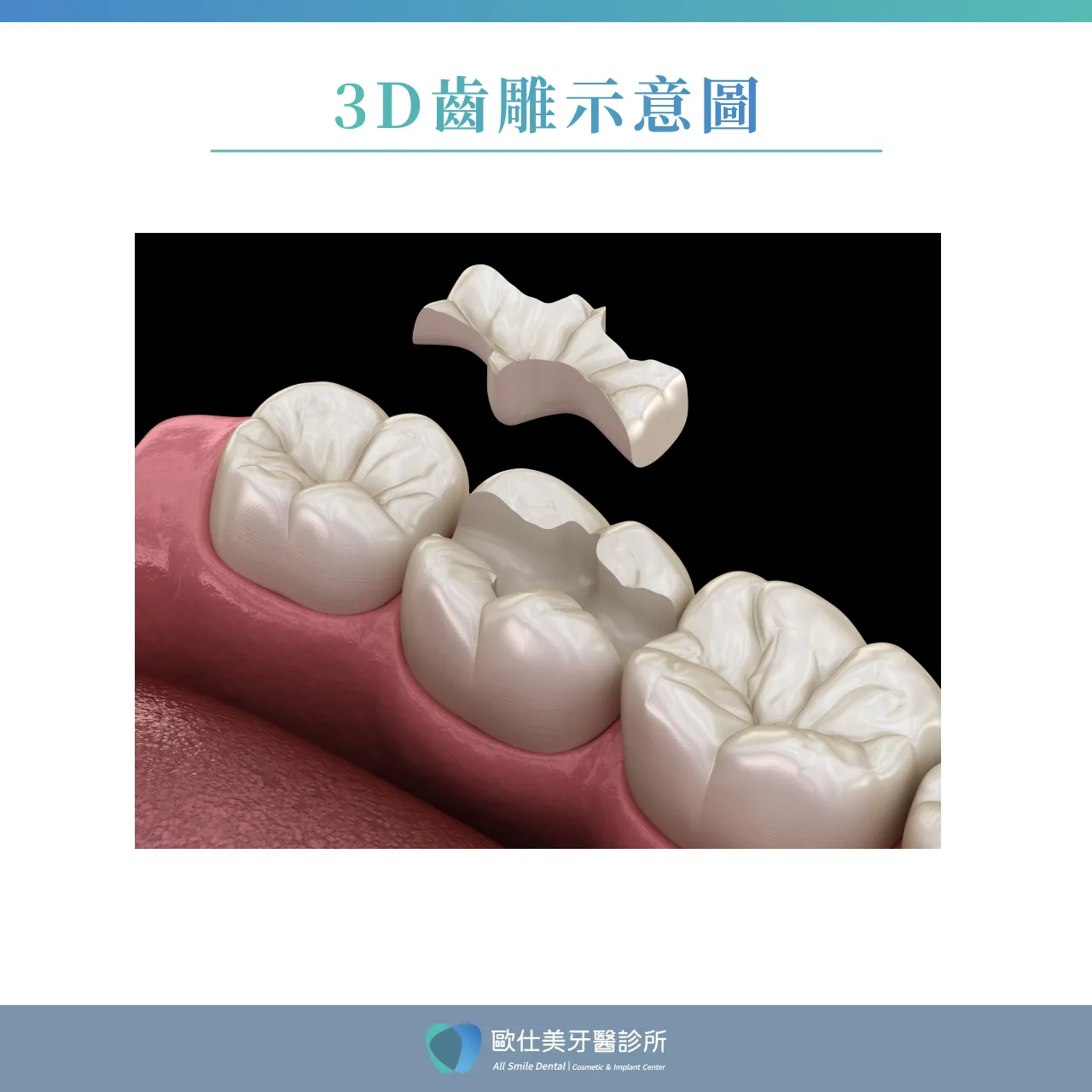 3D齒雕