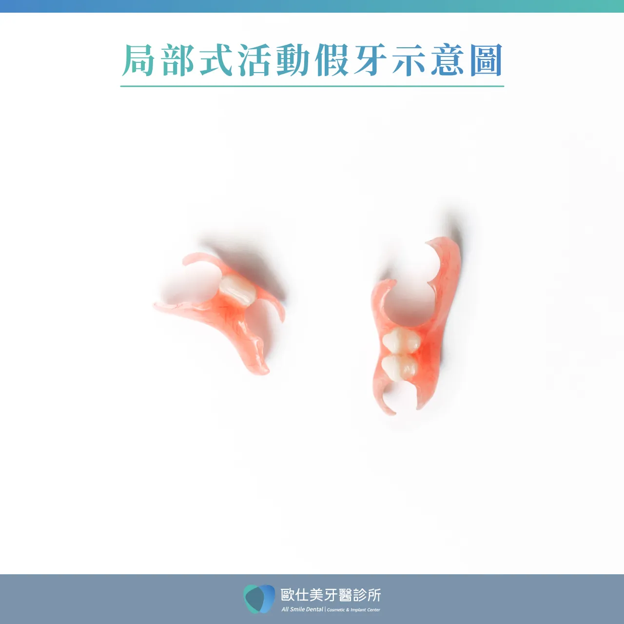 局部式活動假牙