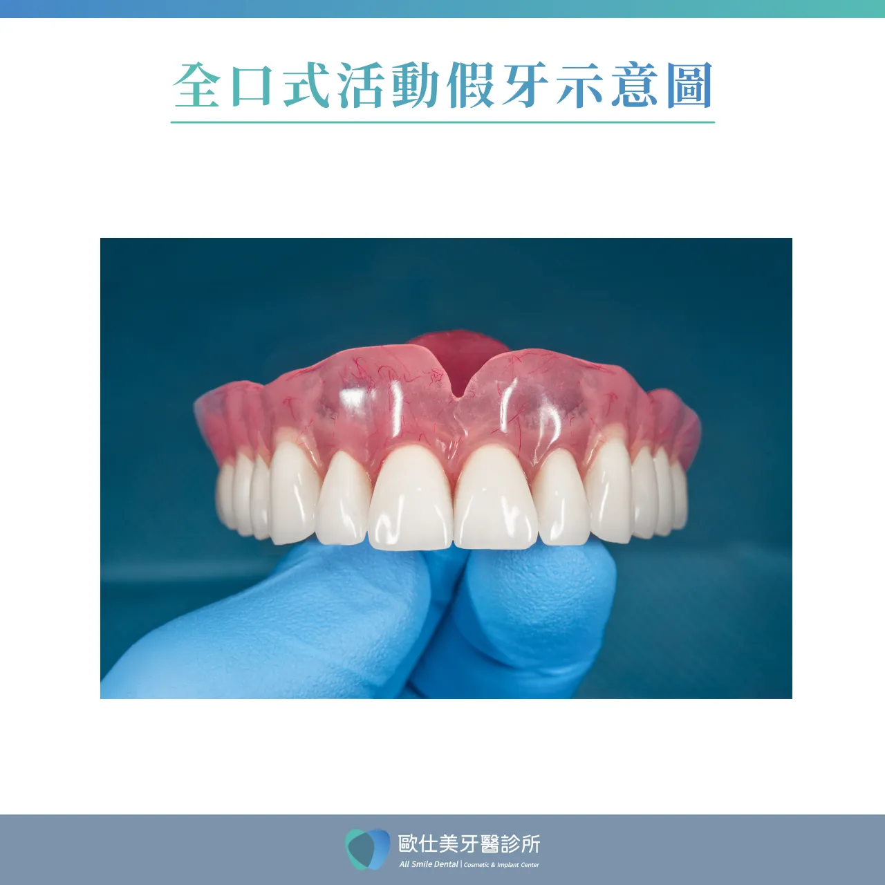 全口式活動假牙