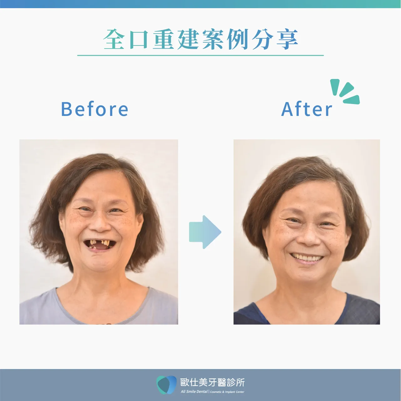 全口重建案例分享1