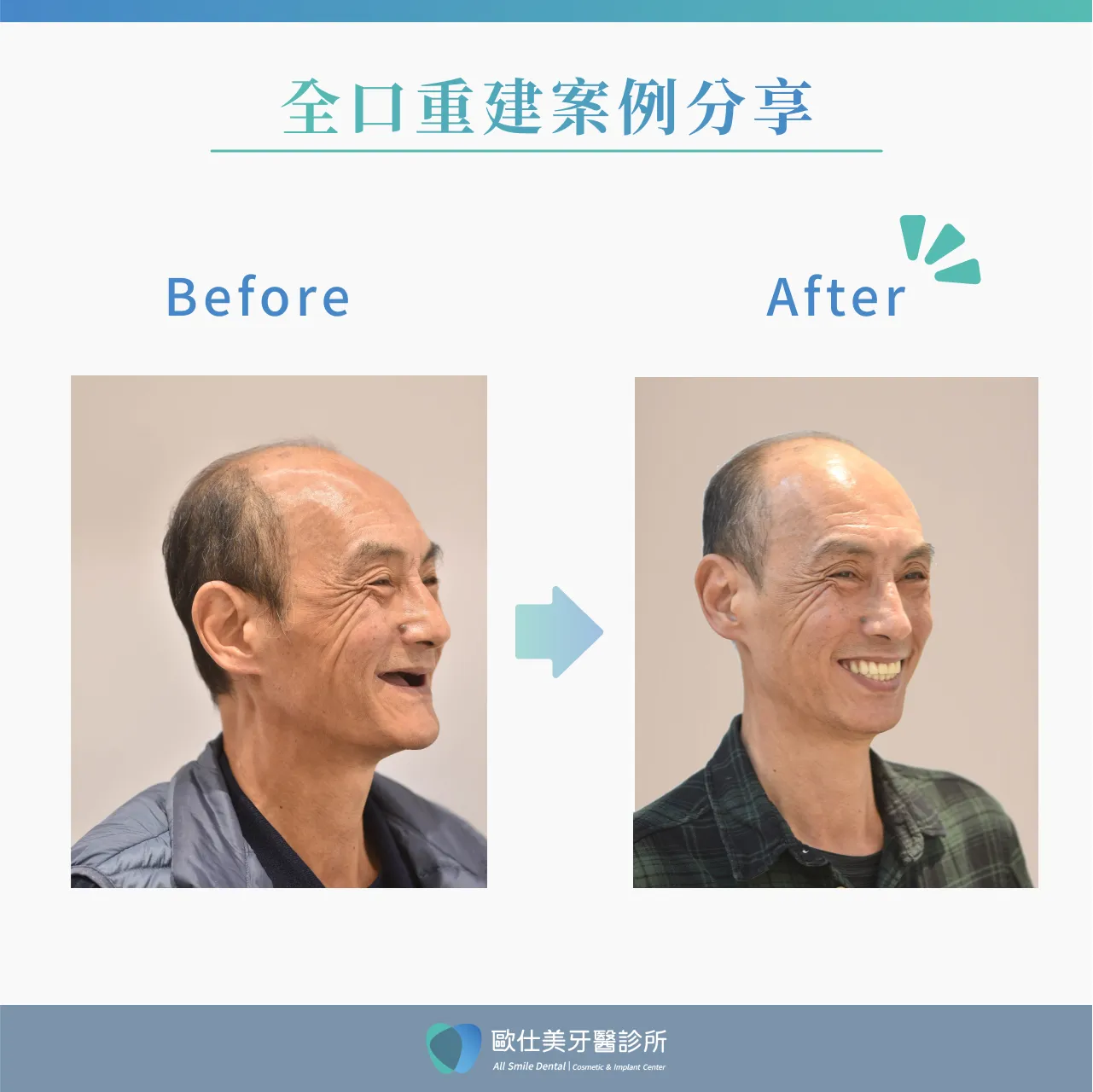 全口重建案例分享2