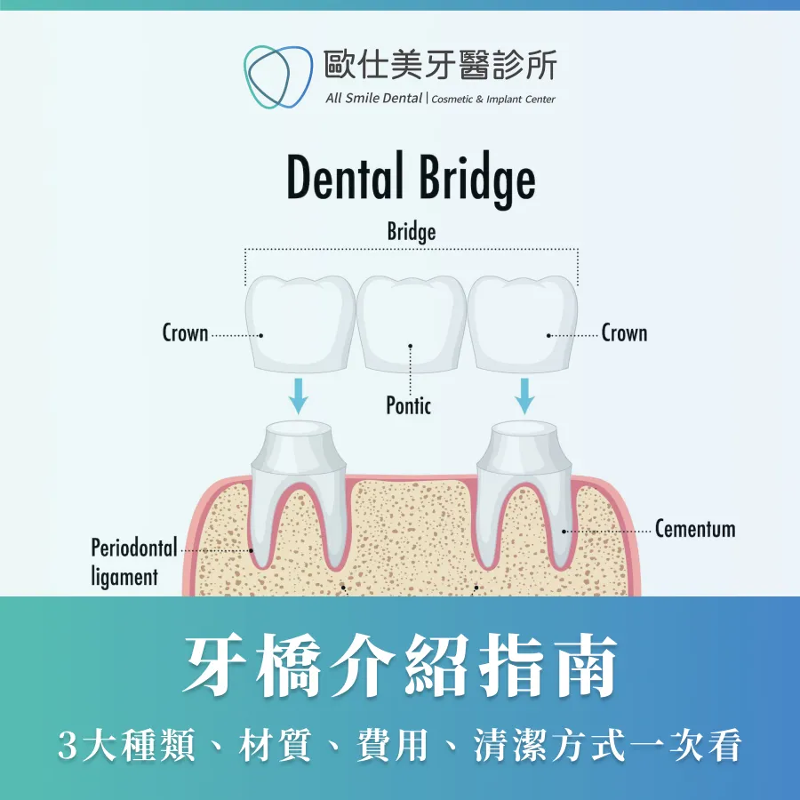 牙橋介紹指南｜3大種類、材質、費用、清潔方式一次看