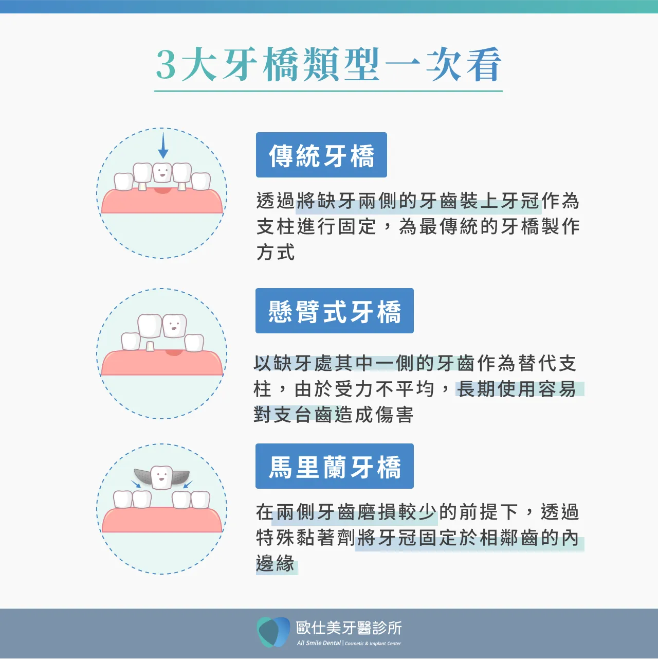 3大牙橋類型