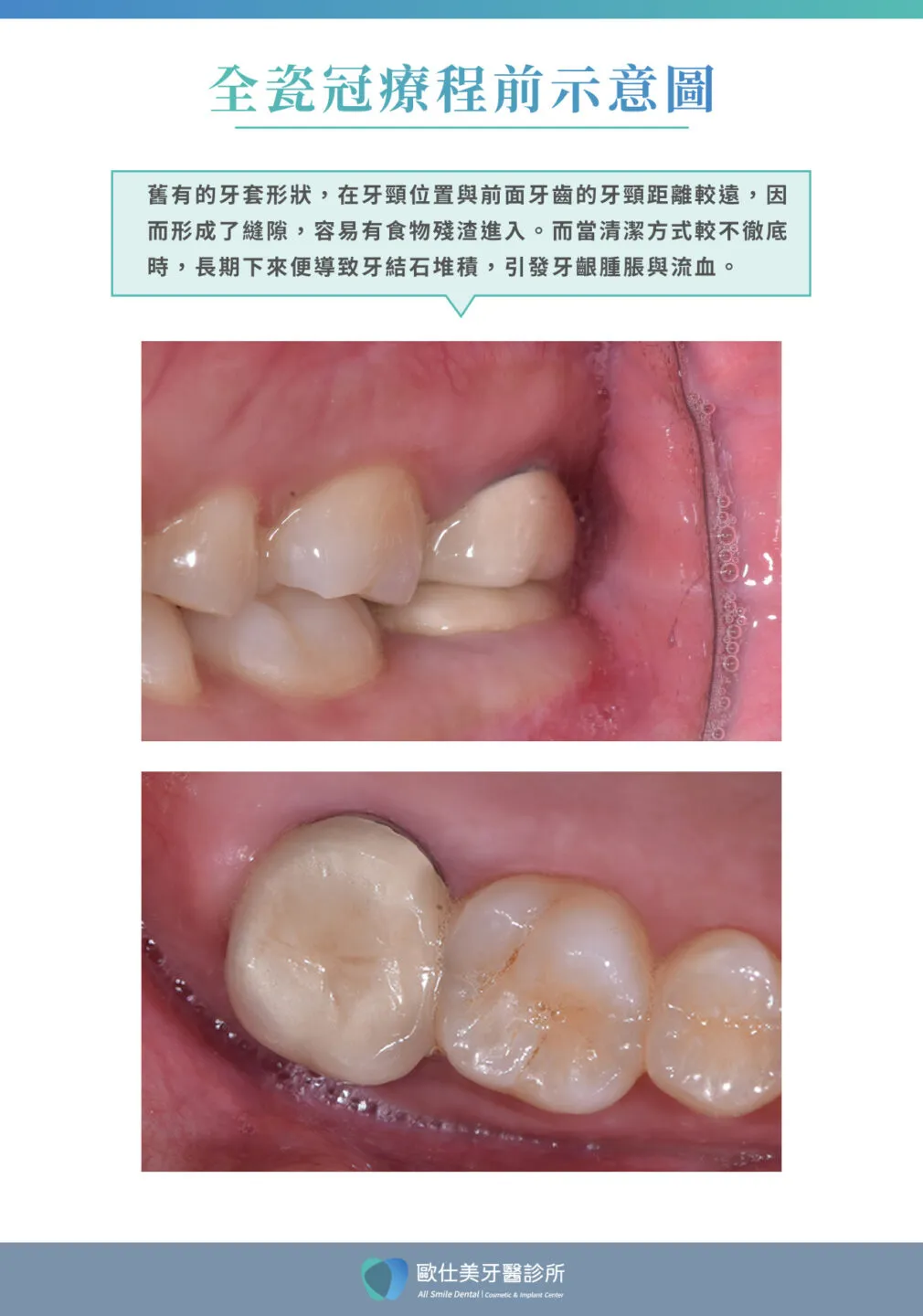 歐仕美5. 全瓷冠案例(療程後)