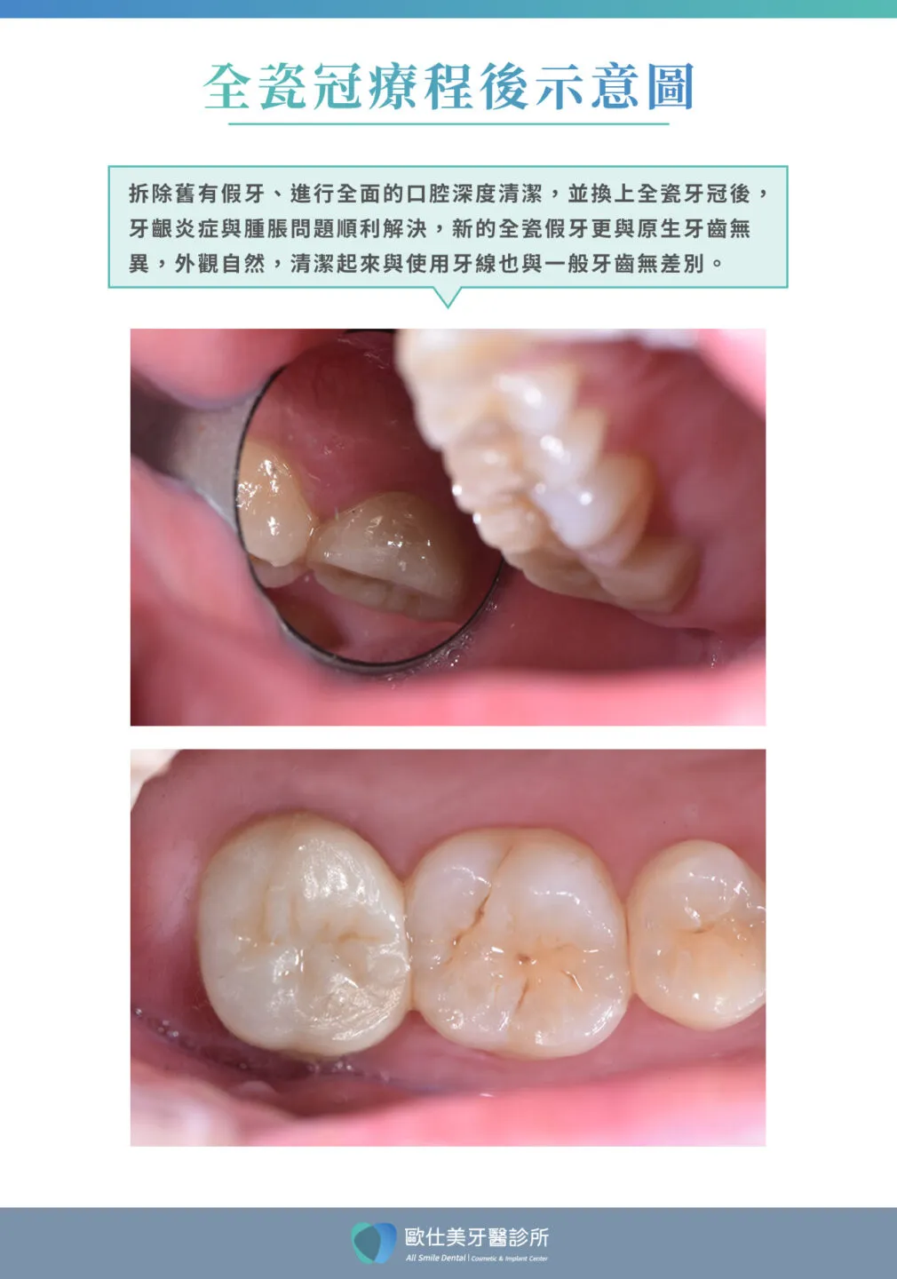 歐仕美5. 全瓷冠案例