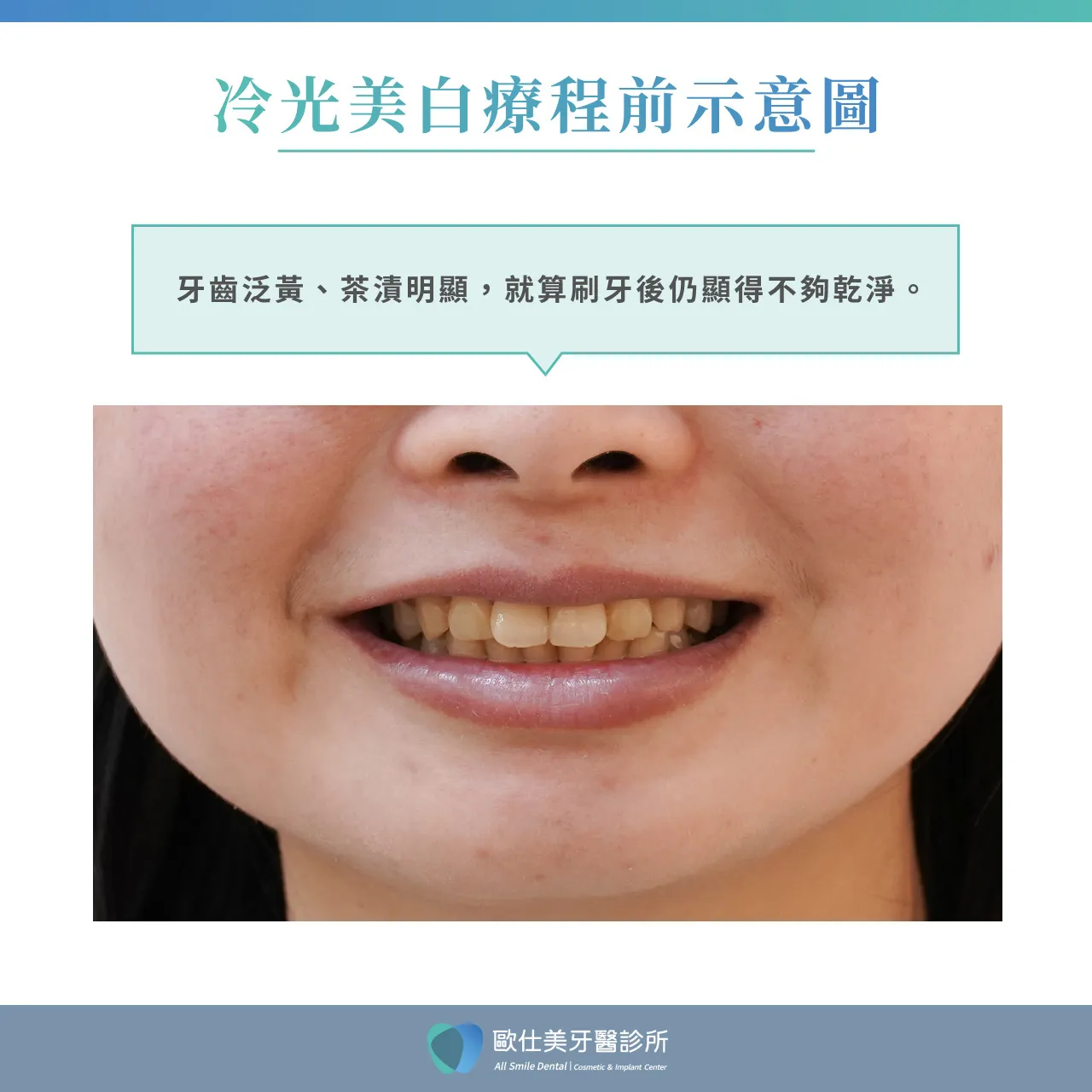 冷光美白療程前示意圖