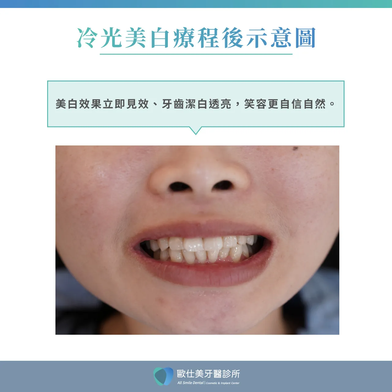 冷光美白療程後示意圖