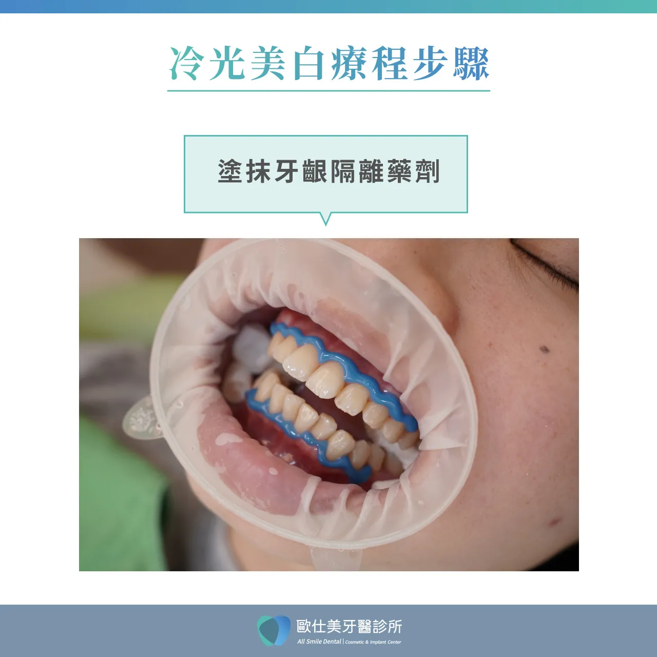 冷光美白療程步驟_塗抹牙齦隔離藥劑