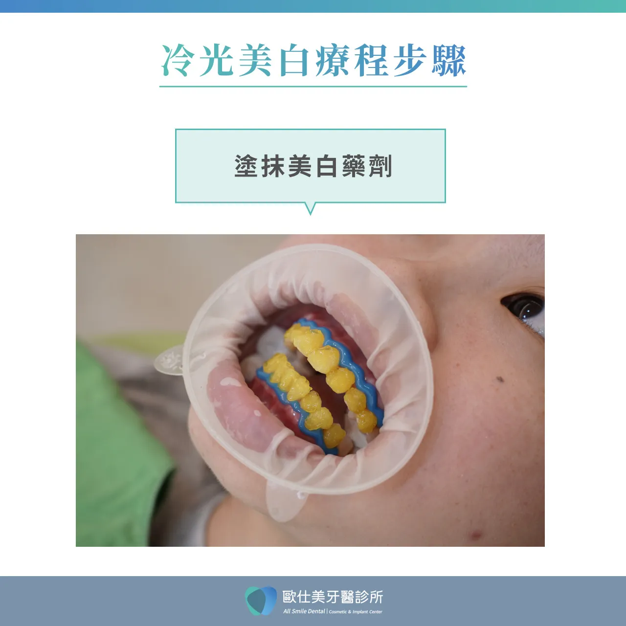 冷光美白療程步驟_塗抹美白藥劑