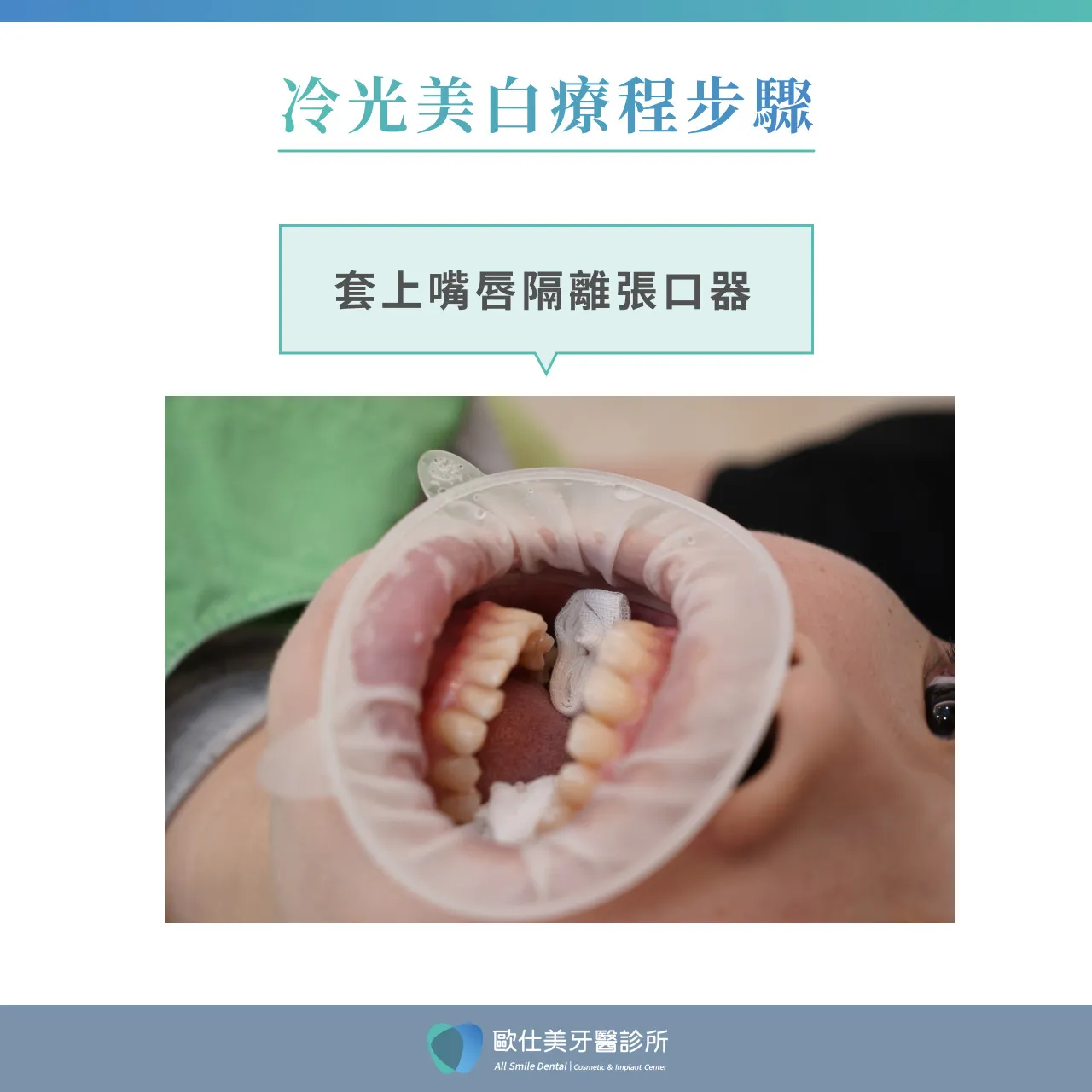 冷光美白療程步驟_套上嘴唇隔離張口器