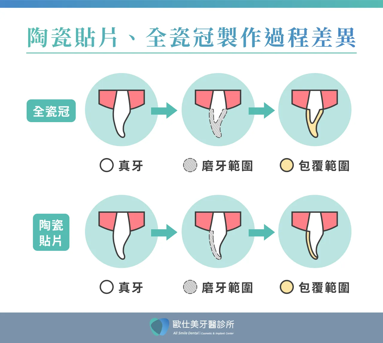 陶瓷貼片、全瓷冠製作過程差異