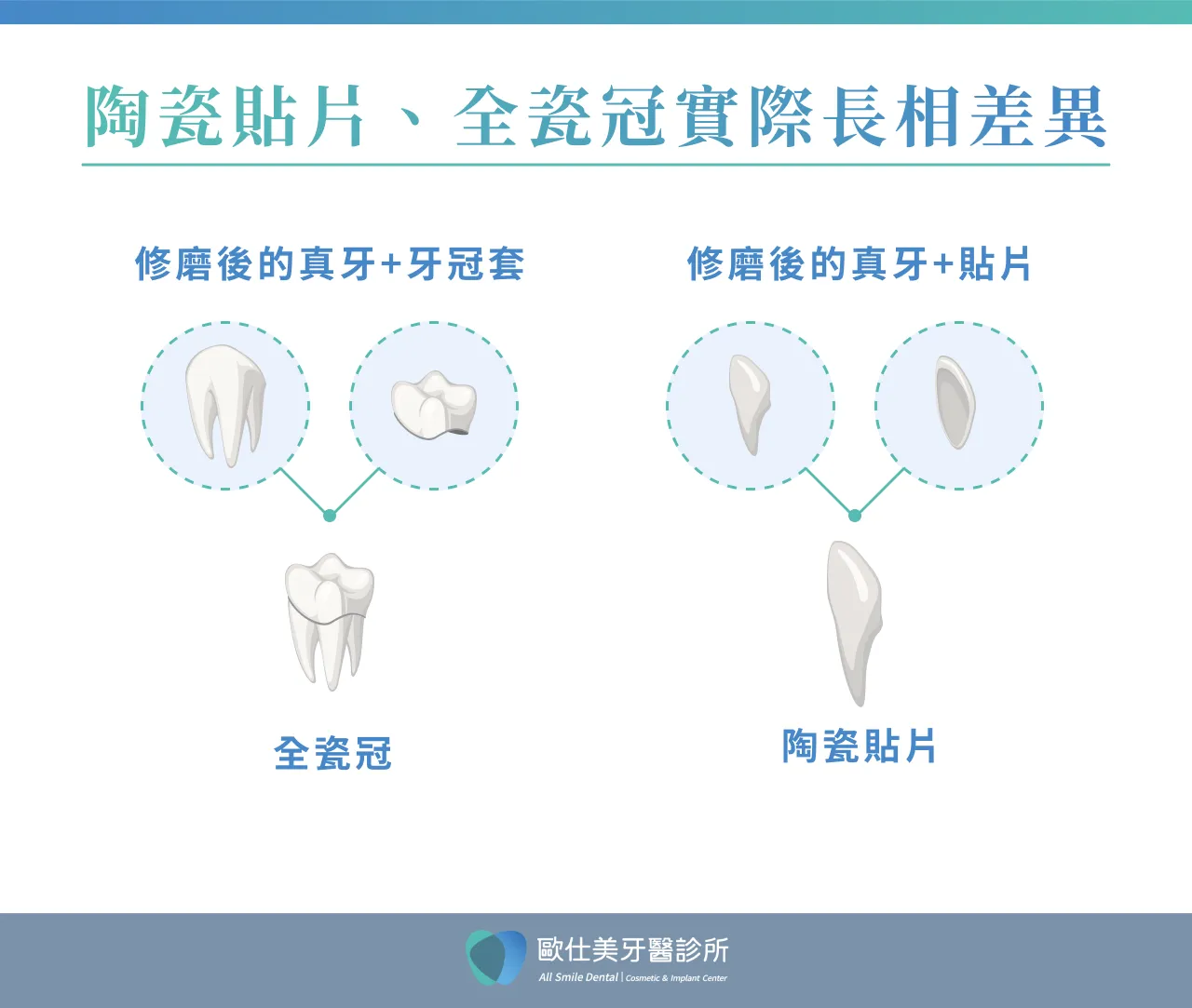 牙齒陶瓷貼片跟全瓷冠有何差異
