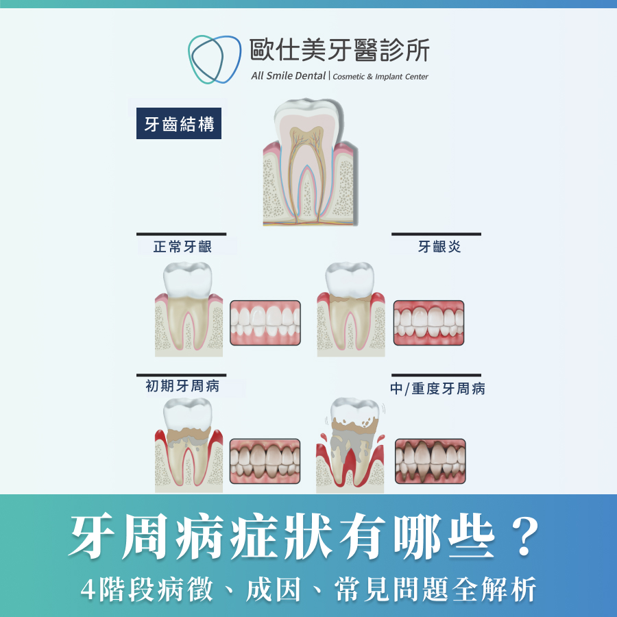 牙周病症狀有哪些？4階段病徵、成因、常見問題全解析