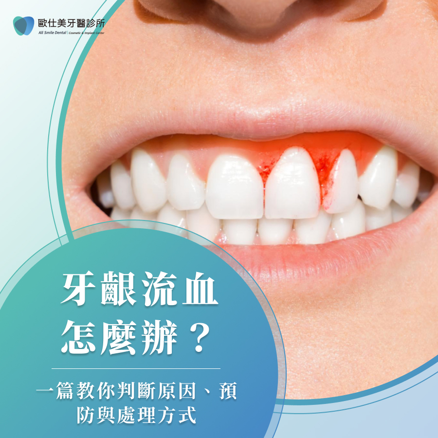 牙齦流血怎麼辦？一篇教你判斷原因、預防與處理方式