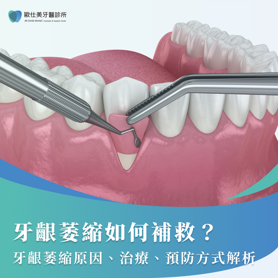 牙齦萎縮如何補救？牙齦萎縮原因、治療、預防方式解析