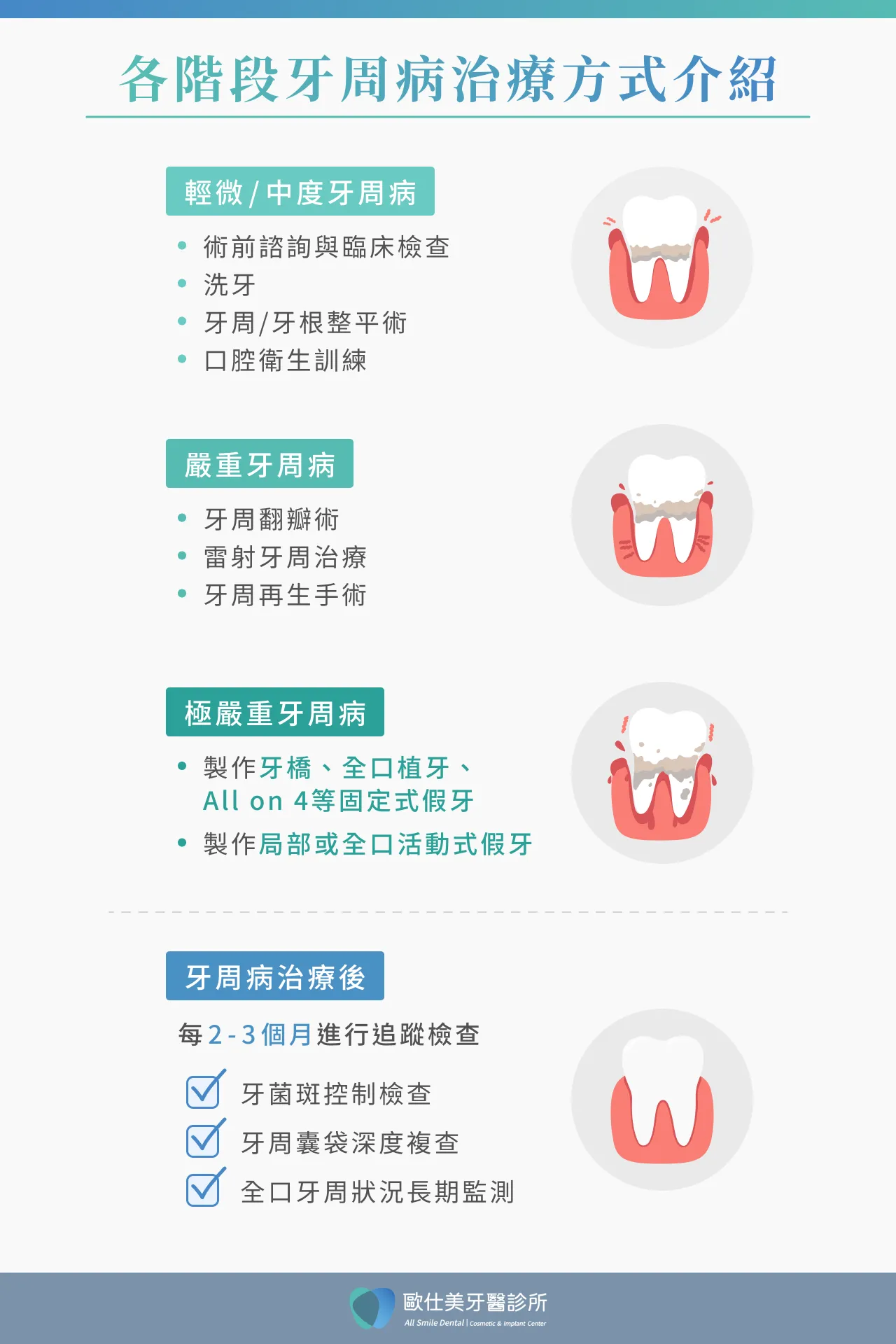 4階段牙周病治療