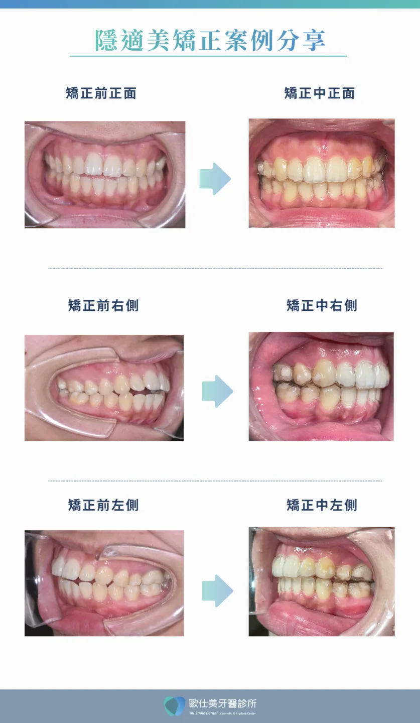 隱適美案例分享
