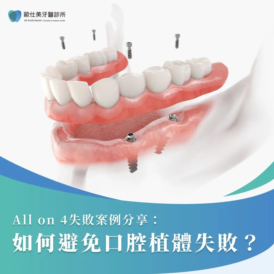 All on 4失敗案例分享：如何避免口腔植體失敗？