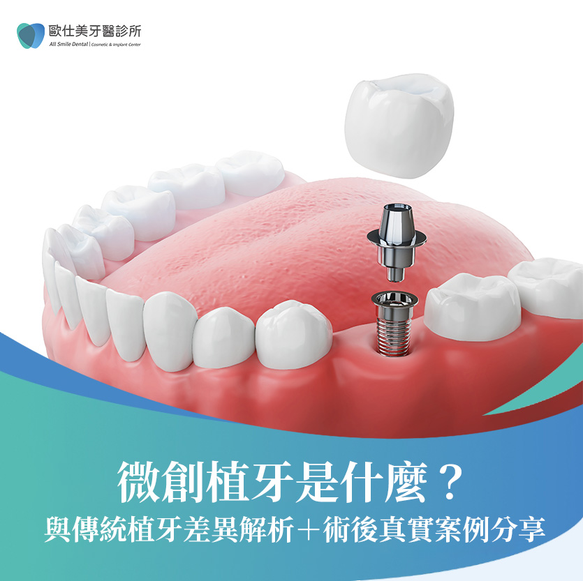 微創植牙是什麼？與傳統植牙差異解析＋術後真實案例分享