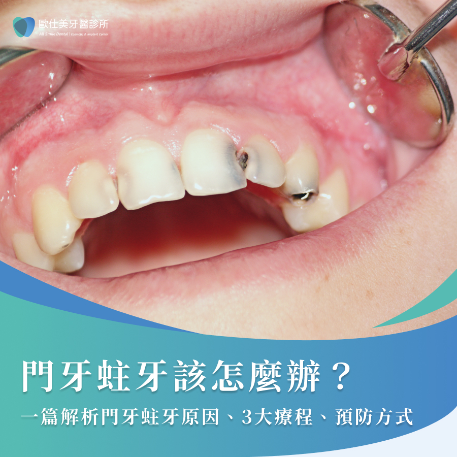 門牙蛀牙該怎麼辦？一篇解析門牙蛀牙原因、3 大療程、預防方式