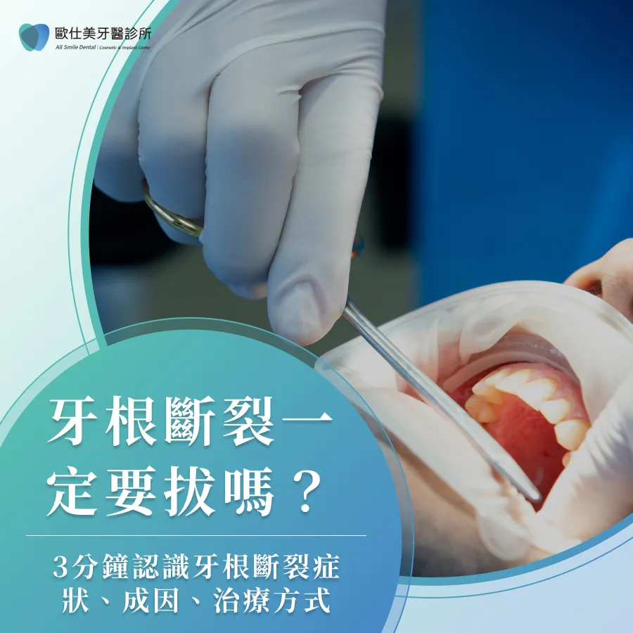 牙根斷裂一定要拔嗎？3分鐘認識牙根斷裂症狀、成因、治療方式
