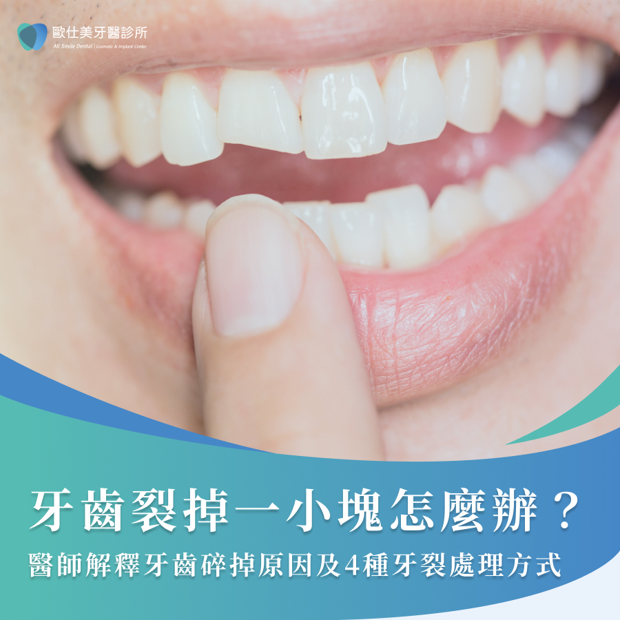 牙齒裂掉一小塊怎麼辦？醫師解釋牙齒碎掉原因及 4種牙裂處理方式