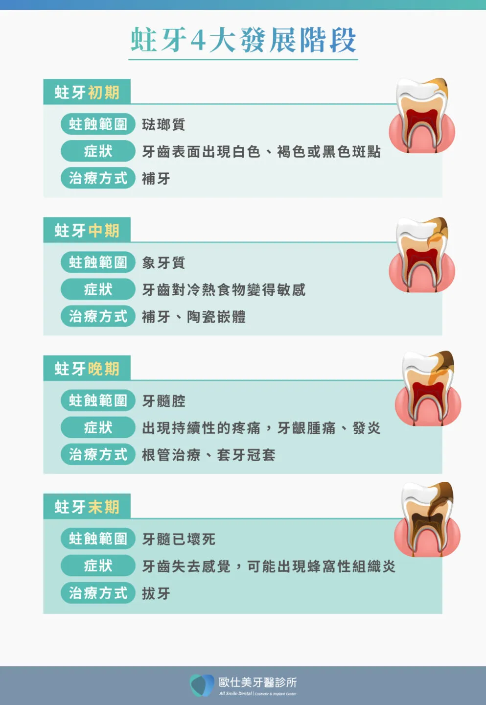蛀牙發展 4 大歷程與對應治療方式
