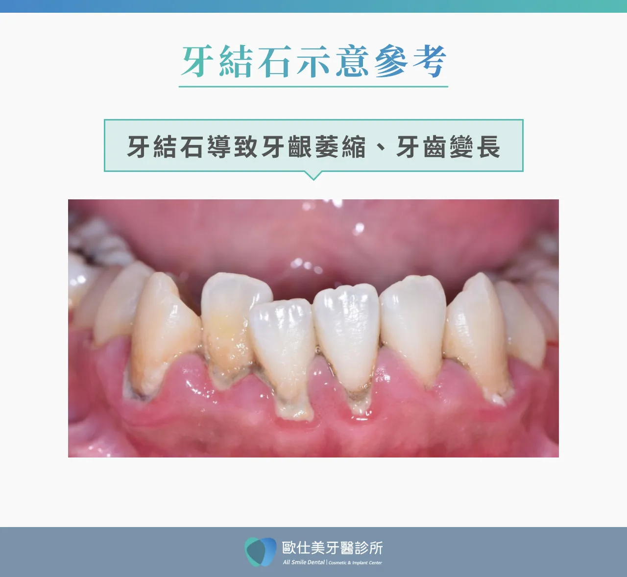 牙結石示意圖