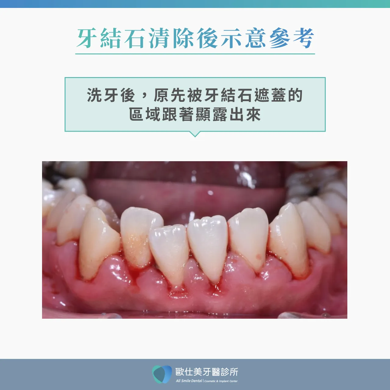 牙結石清除示意圖參考