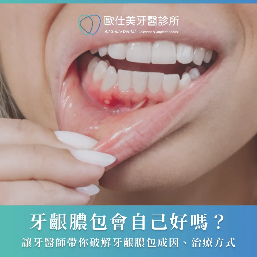 牙齦膿包會自己好嗎？讓牙醫師帶你破解牙齦膿包成因、治療方式