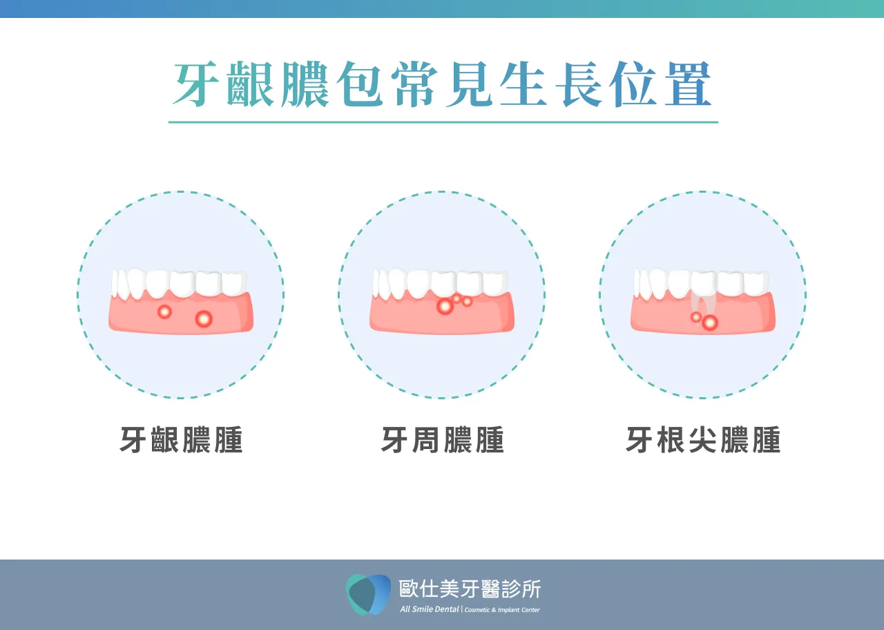 牙齦膿包常見生長位置