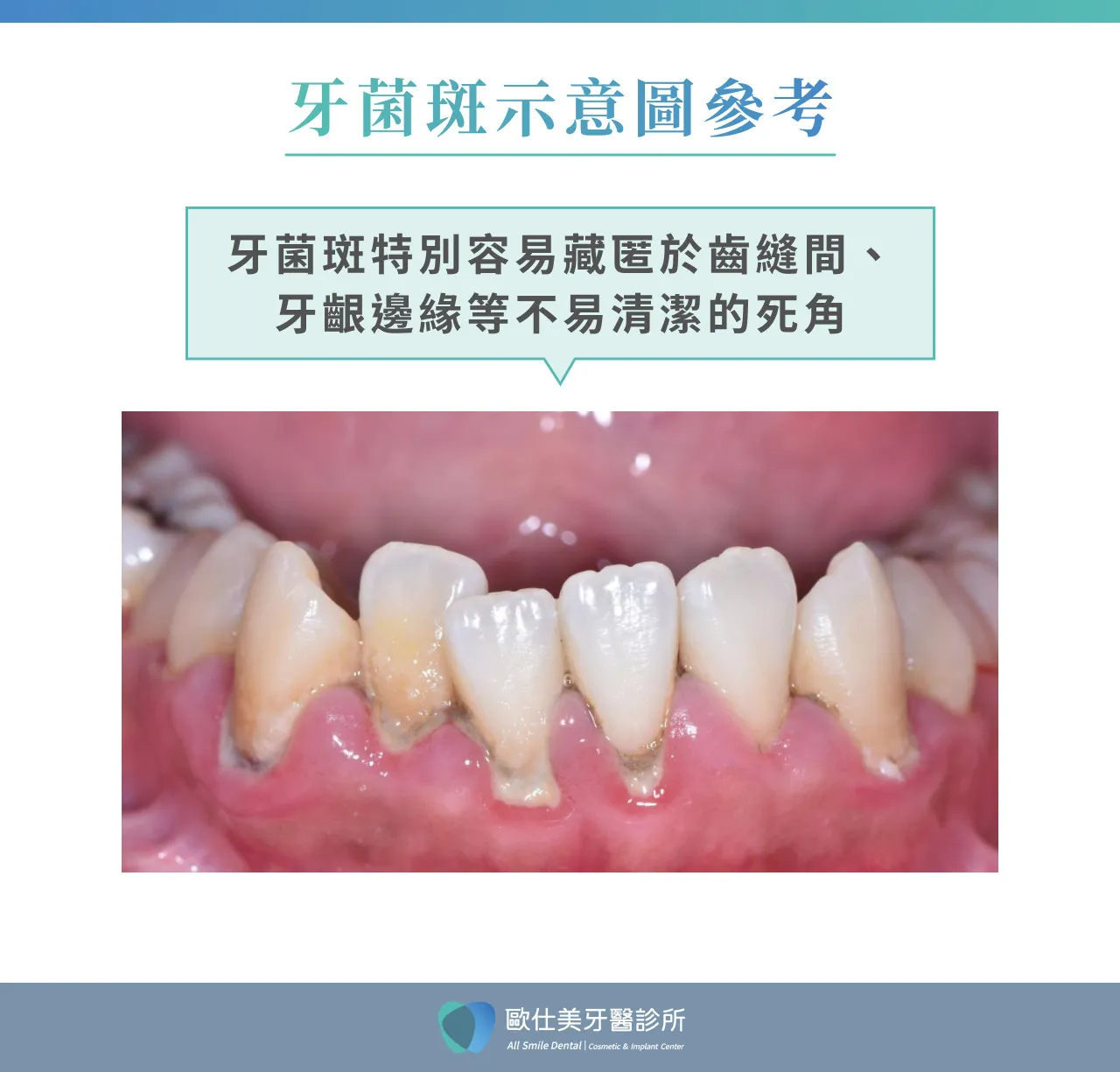牙菌斑示意圖參考