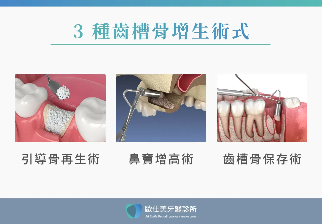 齒槽骨流失可以治療嗎?3種齒槽骨增生術式