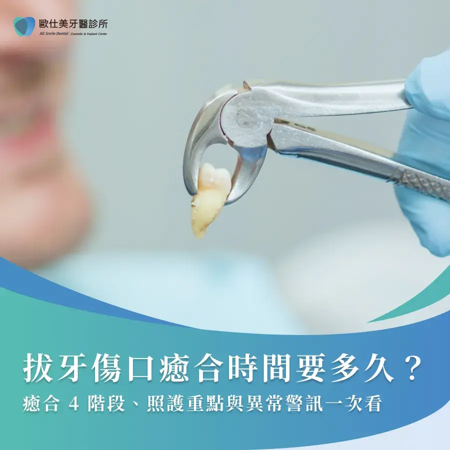 拔牙傷口癒合時間要多久？癒合4階段、照護重點與異常警訊一次看